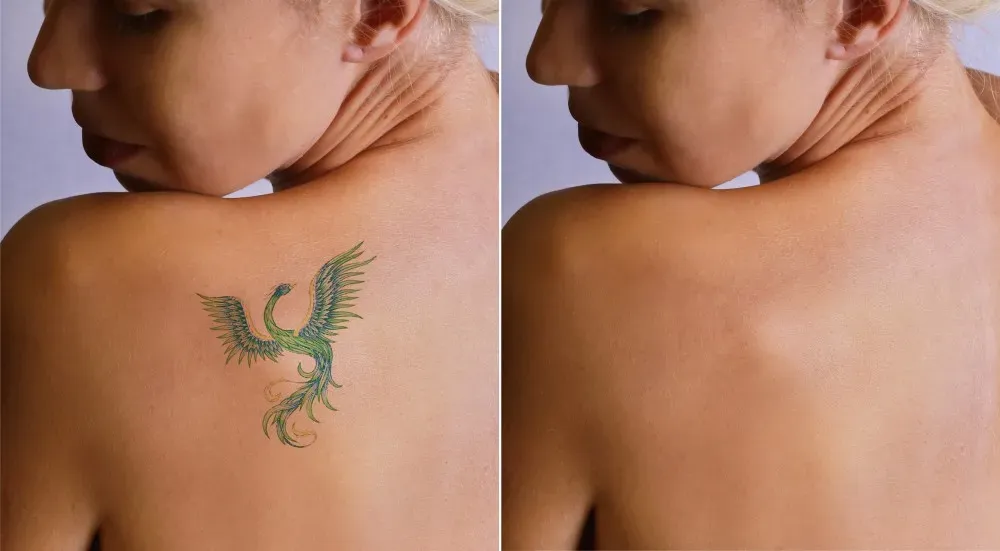 tattoo removal