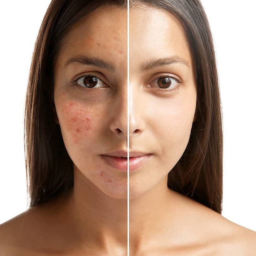 Acne Scar Treatment in Thrissur